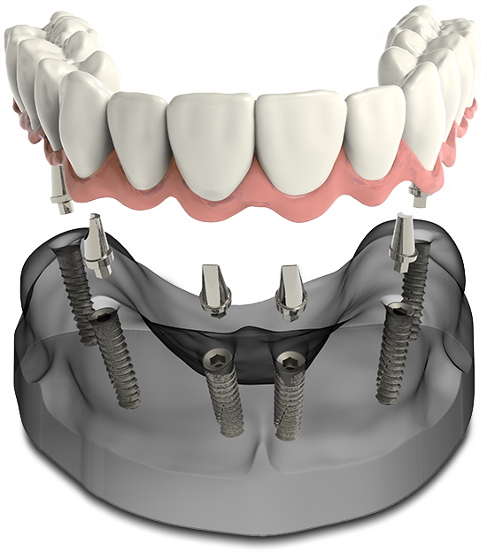 full arch dental implant model