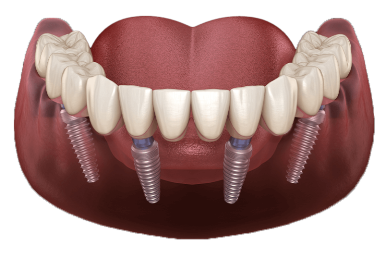 Full & Partial Dentures Gilroy, CA Denture Repair Near Me