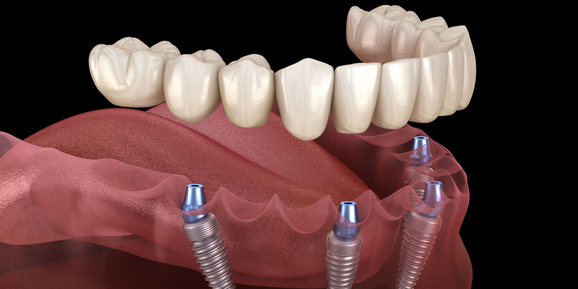 Dental implants mission viejo